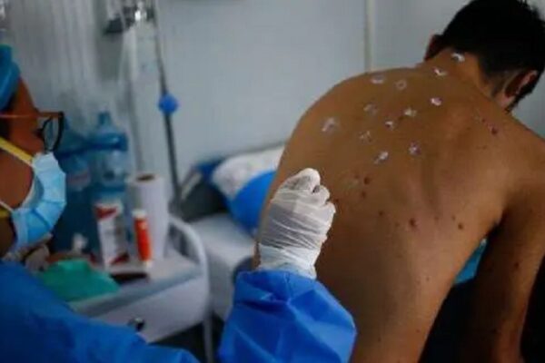 Oruro y Chuquisaca activan vigilancia epidemiológica por viruela símica